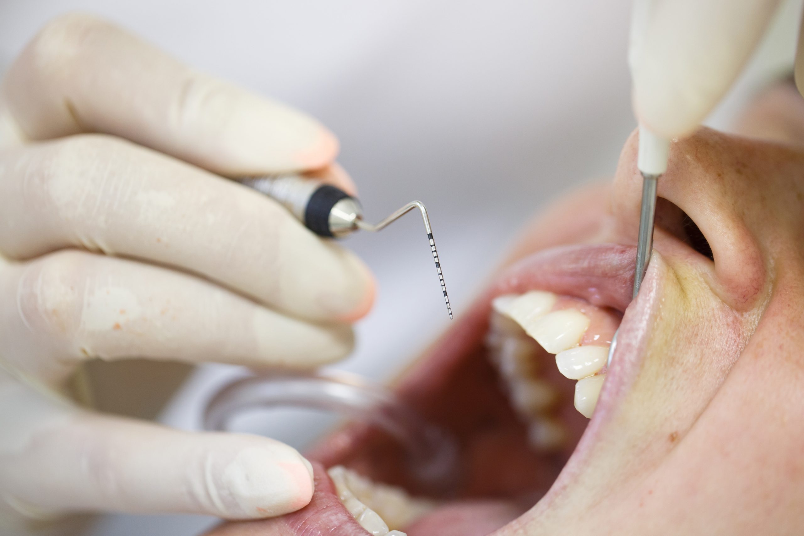 close up of patient receiving teeth cleaning