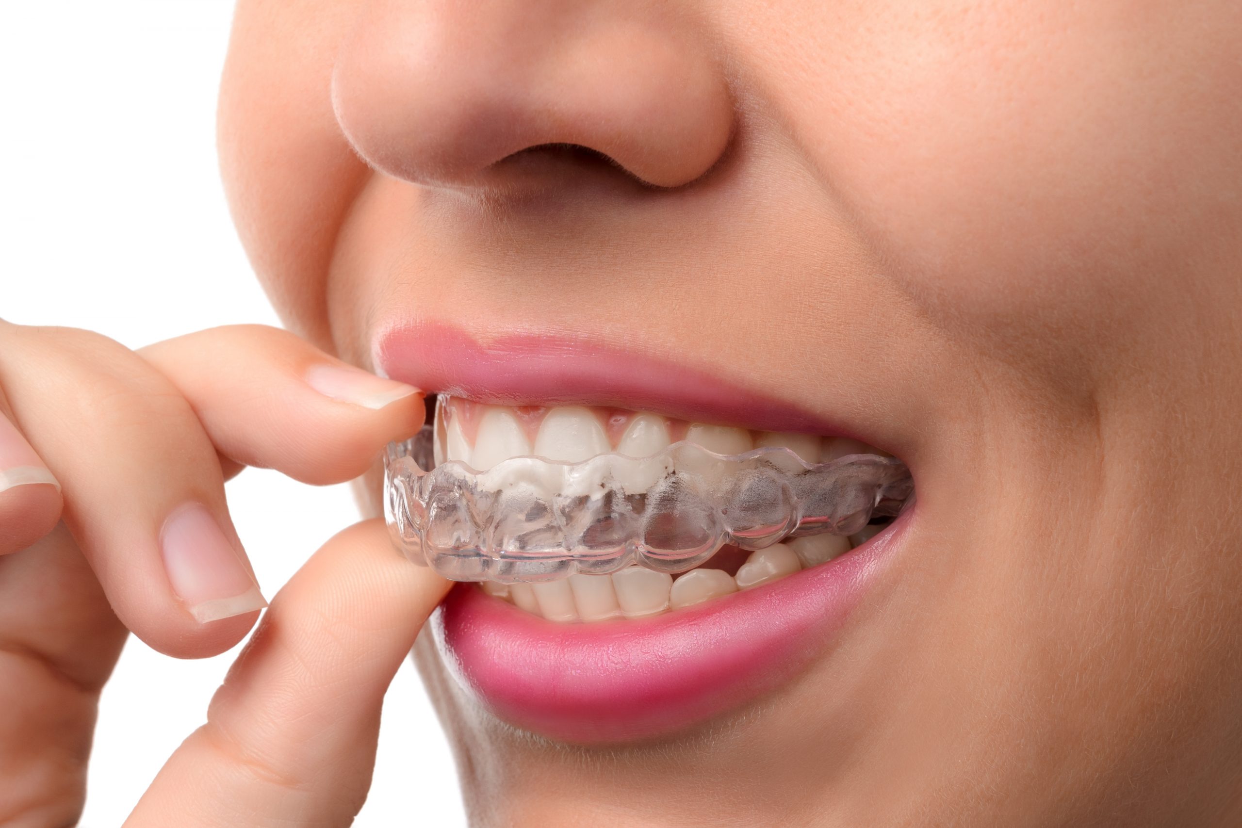 Closeup image of woman taking out her clear Invisalign retainer.