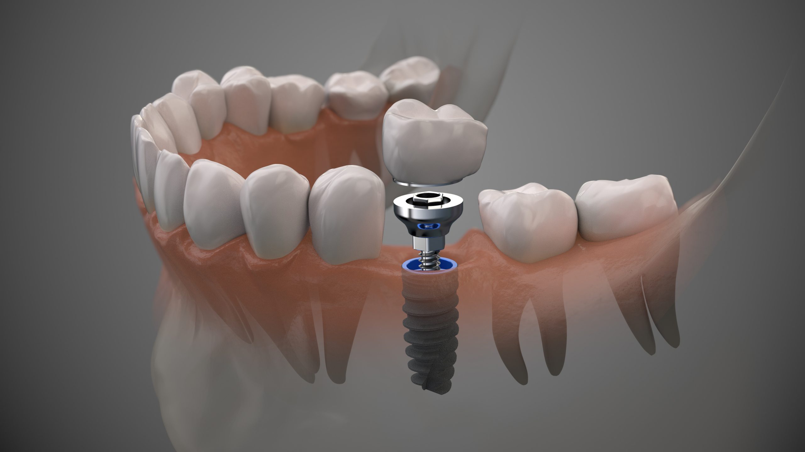Digital rendering a dental implant, abutment, and crown being installed in a lower jaw.