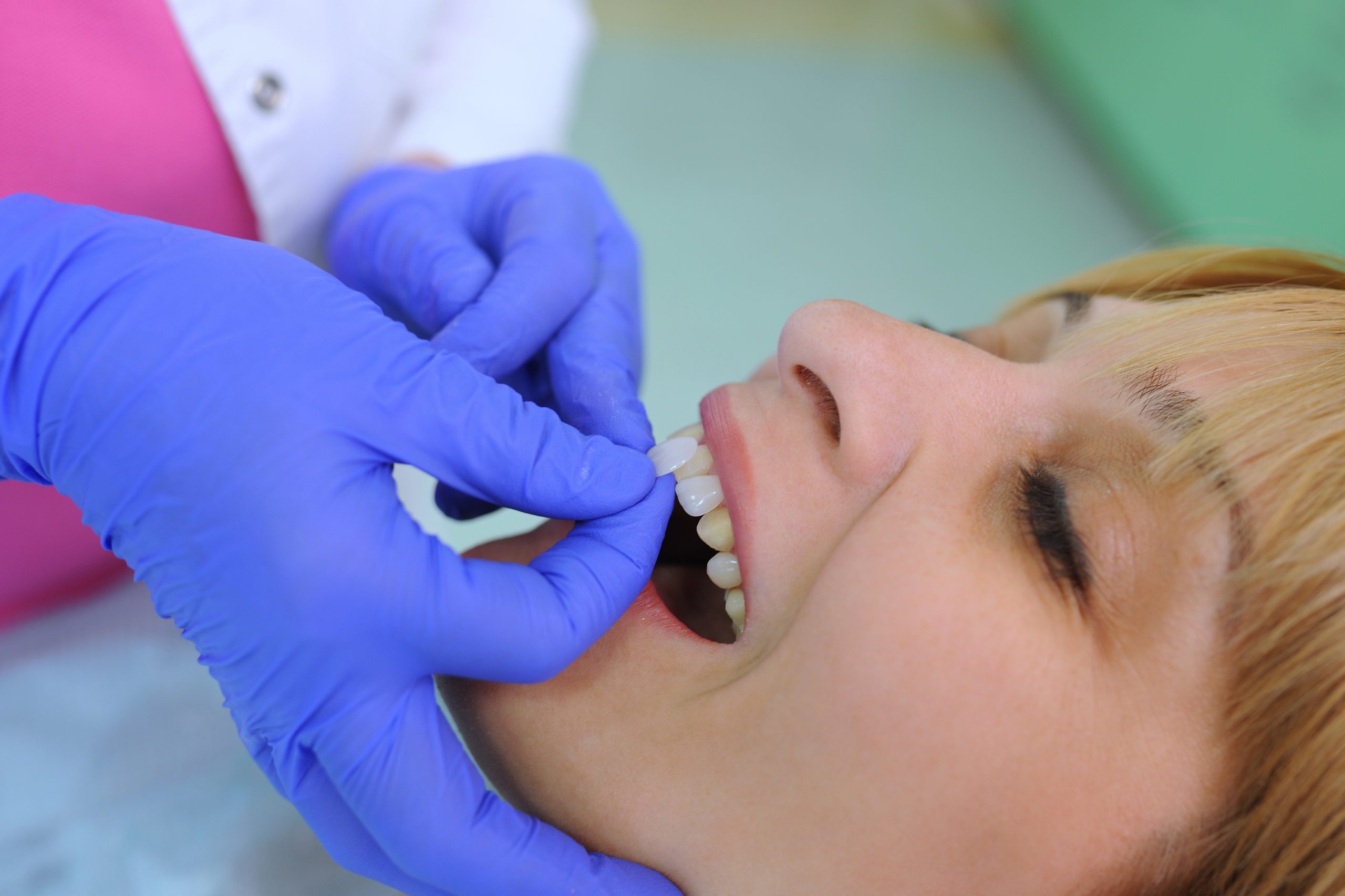 Dentist applying veneers to patient's teeth.