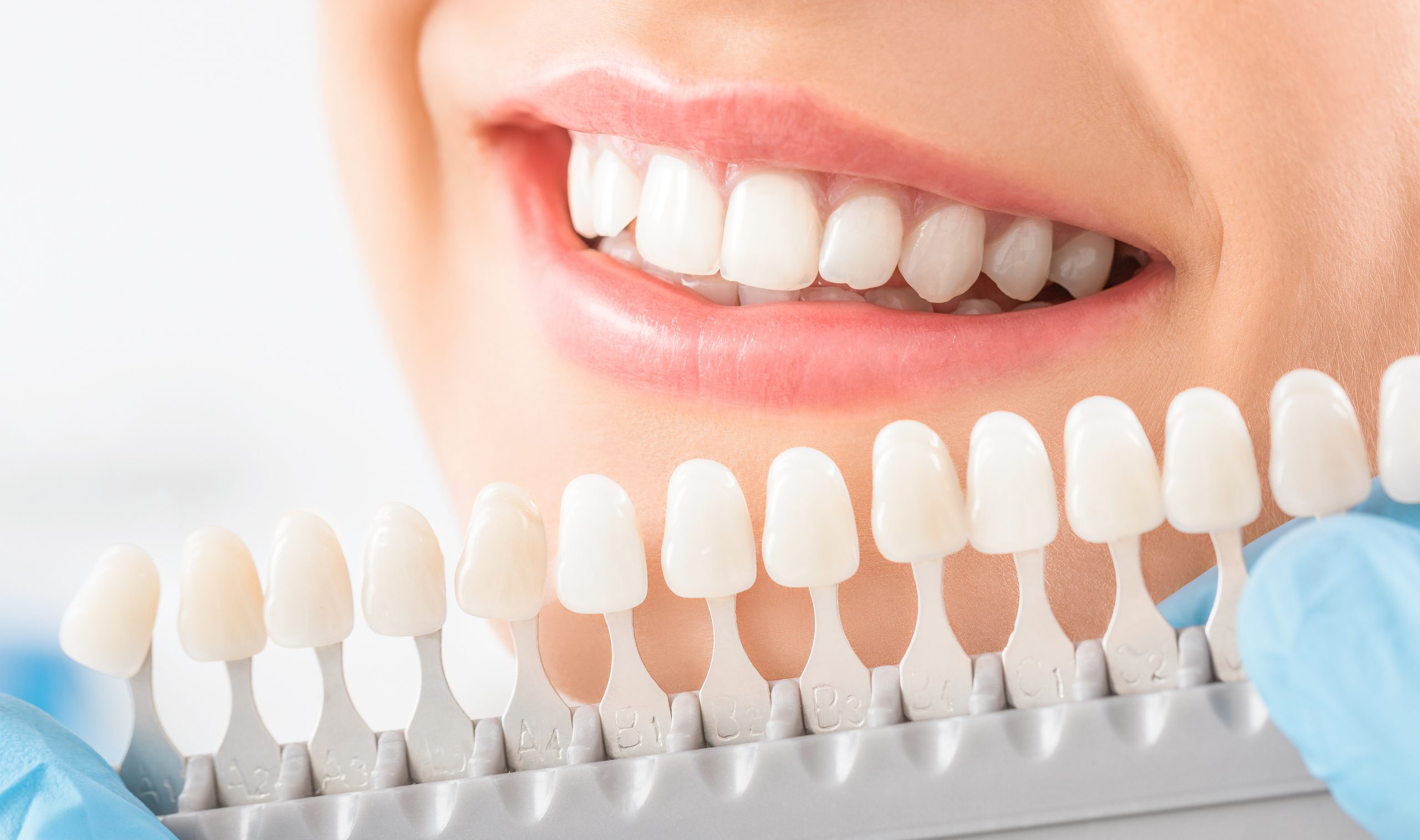 Closeup smile with a teeth whitening scale help next to the smile to compare the tooth color.