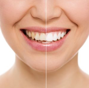 Closeup of someone smiling to show how the before and after results of teeth whitening.