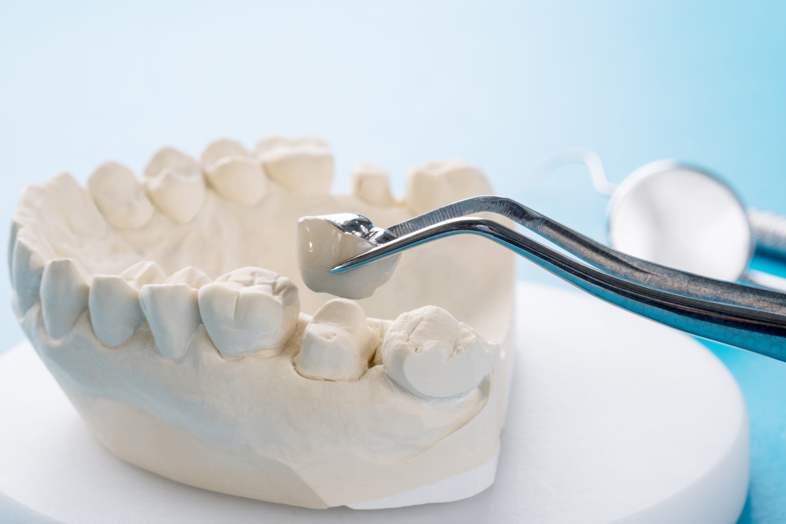 Dentist placing crown on the abutment of an artificial lower dental ridge.